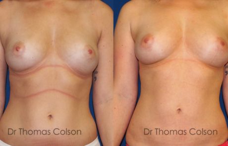 avant-apres-lipofilling-mammaire-poitrine Lipofilling mammaire poitrine