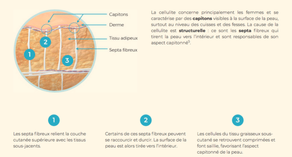 cellulite aix en provence