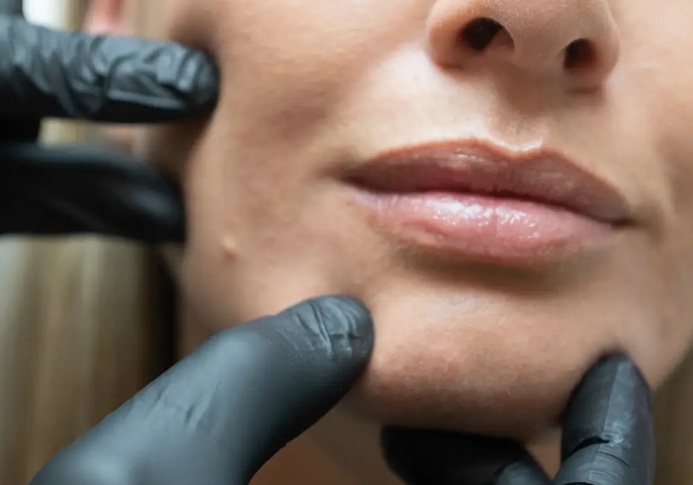 lipofilling-visage-dr-colson