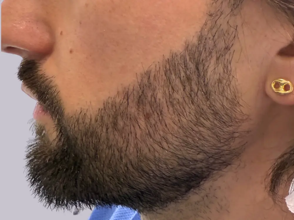 apres-greffe-barbe