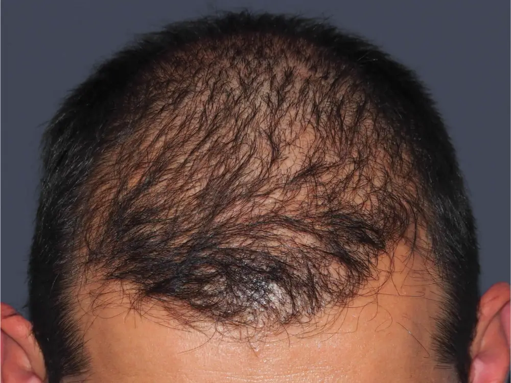 apres-greffe-cheveux