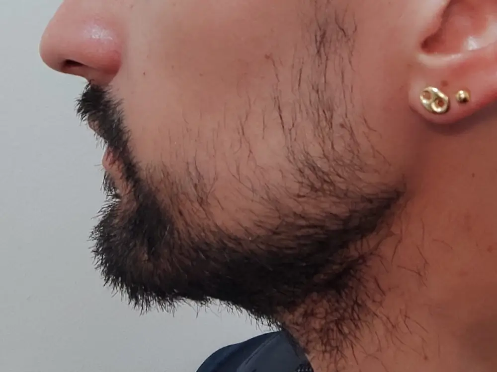 avant-greffe-barbe