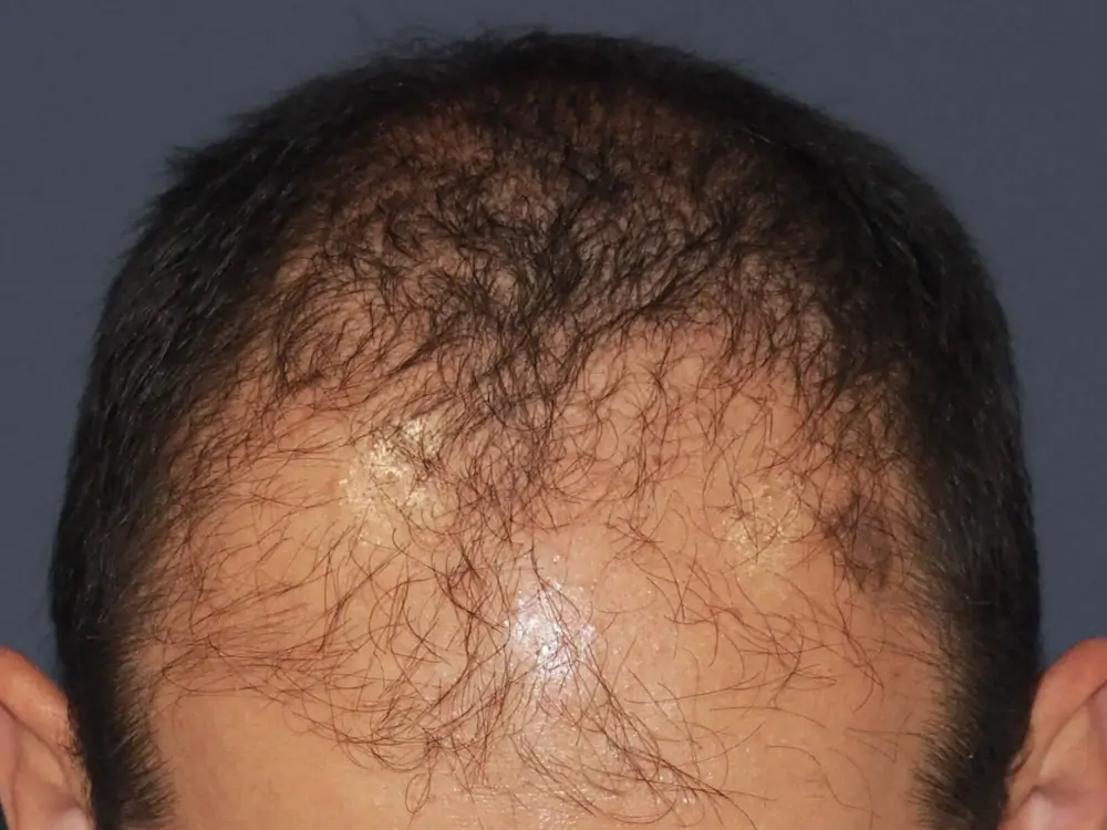 avant-greffe-cheveux