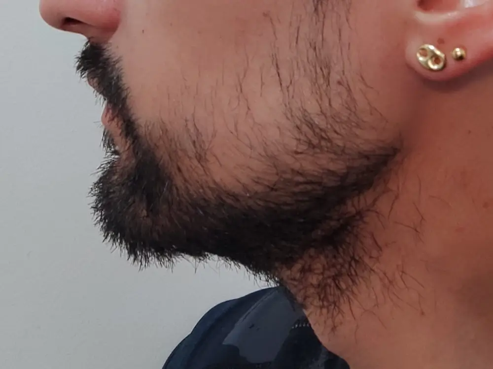 chirurgie-capillaire-greffe-barbe