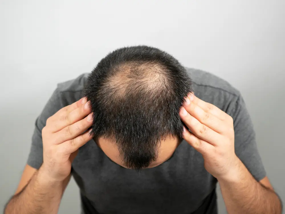 chirurgie-capillaire-traitement-chute-cheveux