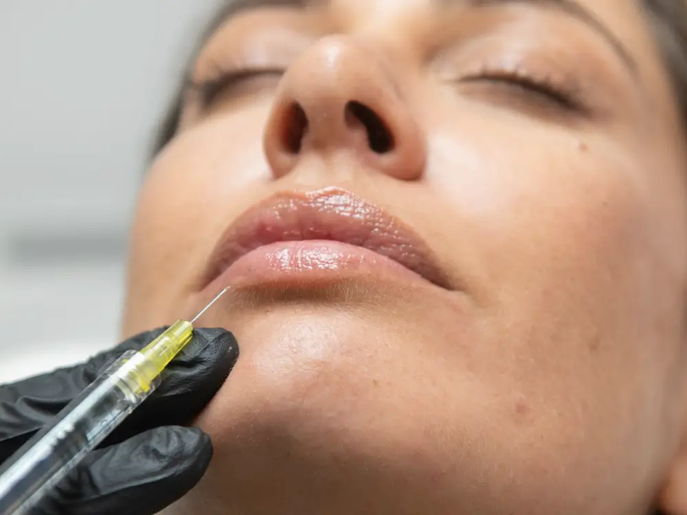 injection-acide-hyaluronique-russian-lips